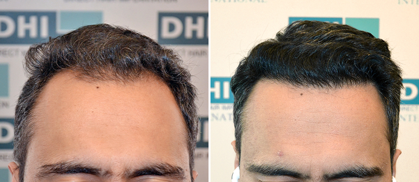 DHI before & after hair transplant results